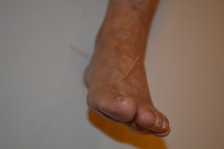 膝痛の鍼治療症例(100) 膝痛の鍼治療症例(100)