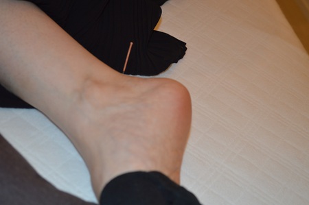 腰痛の鍼治療症例(102) 腰痛の鍼治療症例(102)