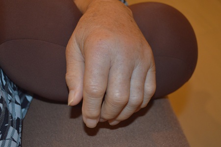 手の腫れの鍼治療症例(6) 手の腫れの鍼治療症例(6)