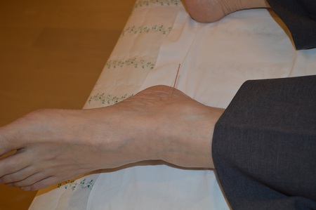 踵の痛みの鍼治療症例(2) 踵の痛みの鍼治療症例(2)