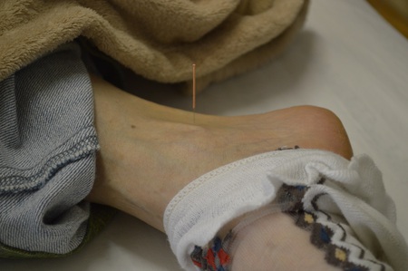 腰痛の鍼治療症例(43) 腰痛の鍼治療症例(43)