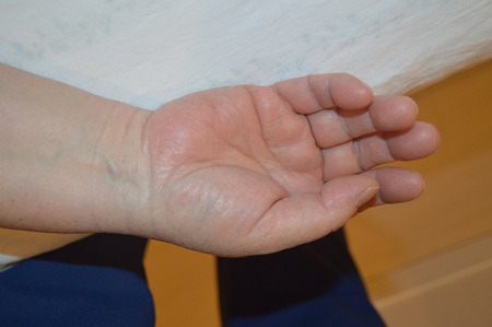 手の腫れの鍼治療症例(10) 手の腫れの鍼治療症例(10)