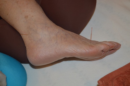 腰痛の鍼治療症例(68) 腰痛の鍼治療症例(68)