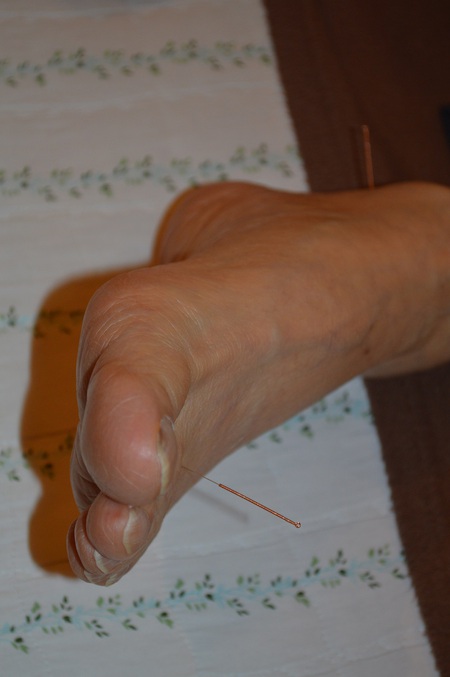 膝痛の鍼治療症例(94) 膝痛の鍼治療症例(94)
