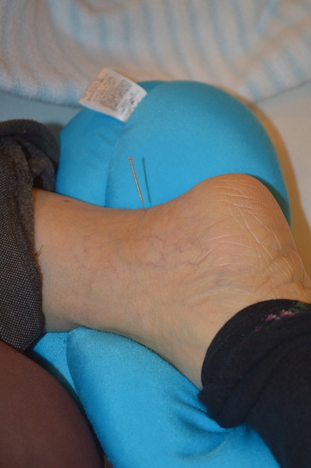 腰痛の鍼治療症例(99) 腰痛の鍼治療症例(99)