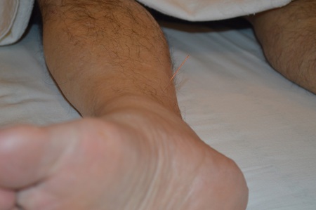 膝痛の鍼治療症例(33) 膝痛の鍼治療症例(33)