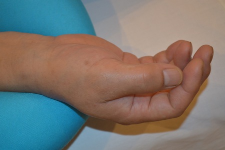 手の腫れの鍼治療症例(3) 手の腫れの鍼治療症例(3)