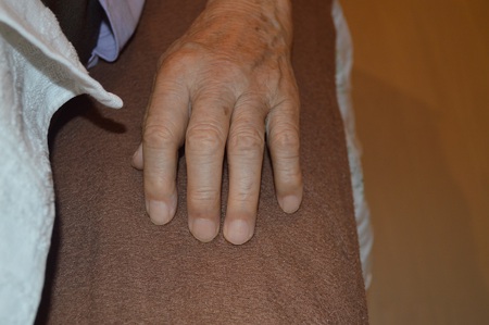 手の腫れの鍼治療症例(6) 手の腫れの鍼治療症例(6)