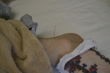 腰痛の鍼治療症例(43) 腰痛の鍼治療症例(43)