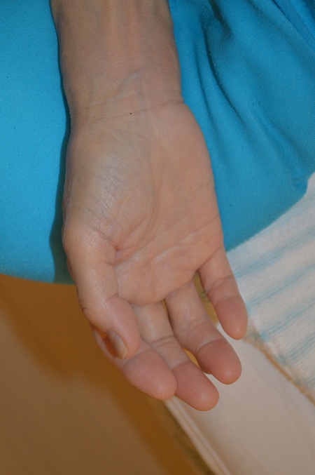 手の腫れの鍼治療症例(9) 手の腫れの鍼治療症例(9)