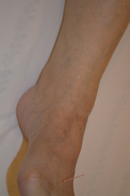 足の腫れの鍼治療症例(18) 足の腫れの鍼治療症例(18)
