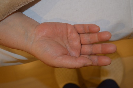 手の腫れの鍼治療症例(10) 手の腫れの鍼治療症例(10)