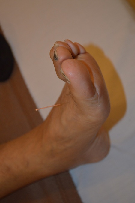 膝痛の鍼治療症例(49) 膝痛の鍼治療症例(49)
