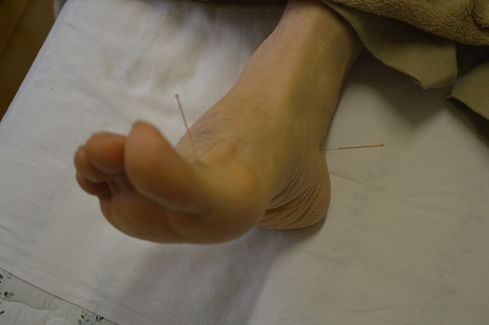膝痛の鍼治療症例(35) 膝痛の鍼治療症例(35)