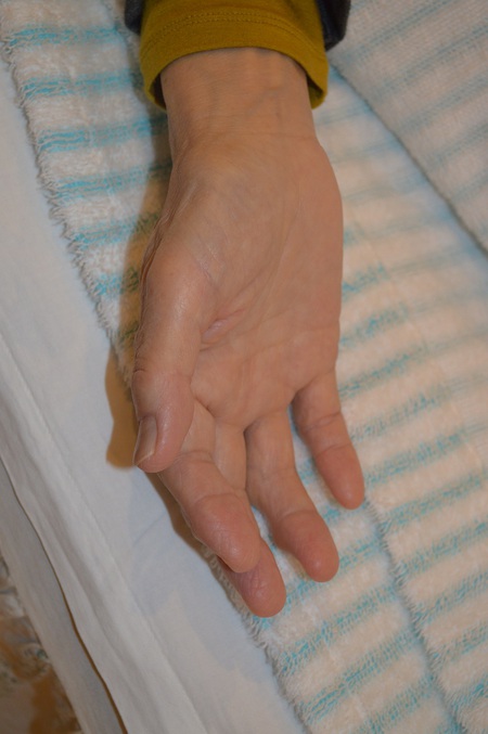 手の腫れの鍼治療症例(9) 手の腫れの鍼治療症例(9)