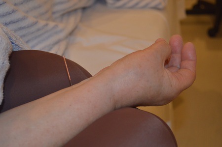 踵の痛みの鍼治療症例(7) 踵の痛みの鍼治療症例(7)