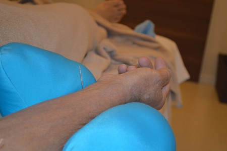 帯状疱疹の鍼治療症例(11) 帯状疱疹の鍼治療症例(11)