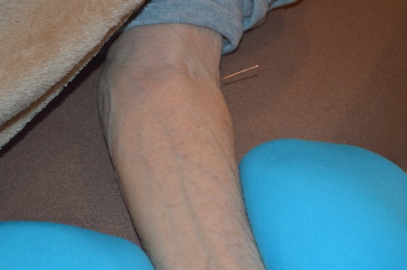 膝痛の鍼治療症例(53) 膝痛の鍼治療症例(53)