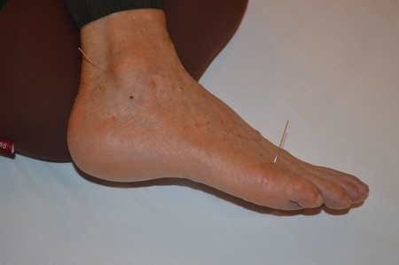 腰痛の鍼治療症例(54) 腰痛の鍼治療症例(54)