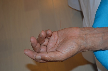 腰痛の鍼治療症例(54) 腰痛の鍼治療症例(54)