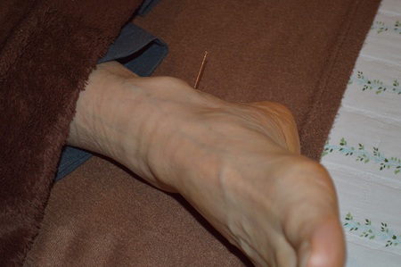 膝痛の鍼治療症例(41) 膝痛の鍼治療症例(41)