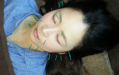 美容鍼1 美容鍼1