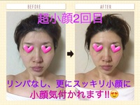 超小顔2回目♥ 2016/06/18 01:05:53
