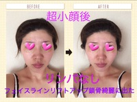 超小顔に若返り♥ 2016/06/18 00:56:06