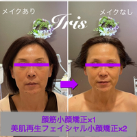 シミ、シワ、たるみや毛穴開き、小顔もお任せ❤︎Irisのフェイシャルケア❤︎ 2023/07/07 21:43:30