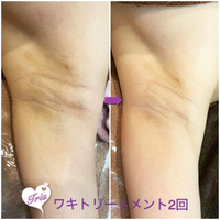 ワキのトリートメント❤︎薄着の季節&ブライダルエステでも❤︎ 2023/08/12 16:35:07