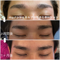 ノンケミカルブロウラミネーション男性経過観察