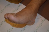 足底腱膜炎の鍼治療症例（５） 2021/01/29 08:39:51