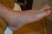 捻挫の鍼治療症例（１４）