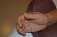 のどの痛みの鍼治療症例（５）