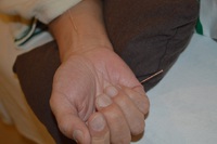 めまいの鍼治療症例（１１）