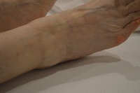 足首の腫れの鍼治療症例（６６） 2020/05/15 08:46:43