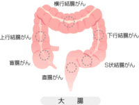 ●初期症状の約７０％に、痔出血と間違えるほど鮮やかな出血がみられる病気